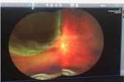 inside my eye